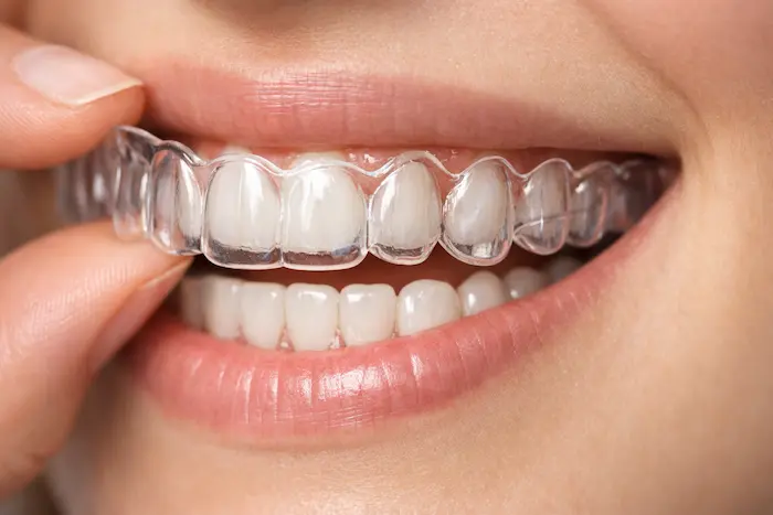 invisalign avicennadis