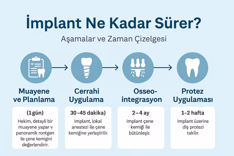 Implant Ne Kadar Surer